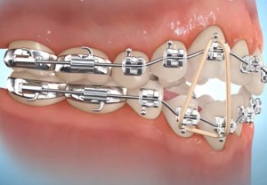Port d'élastiques en orthodontie