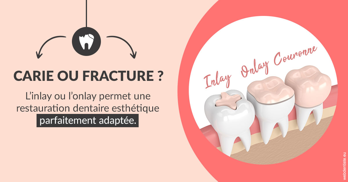 https://dr-juzan-cecile.chirurgiens-dentistes.fr/T2 2023 - Carie ou fracture 2