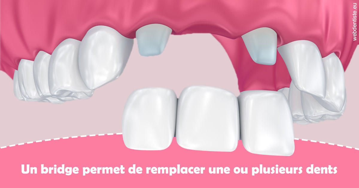 https://dr-juzan-cecile.chirurgiens-dentistes.fr/Bridge remplacer dents 2