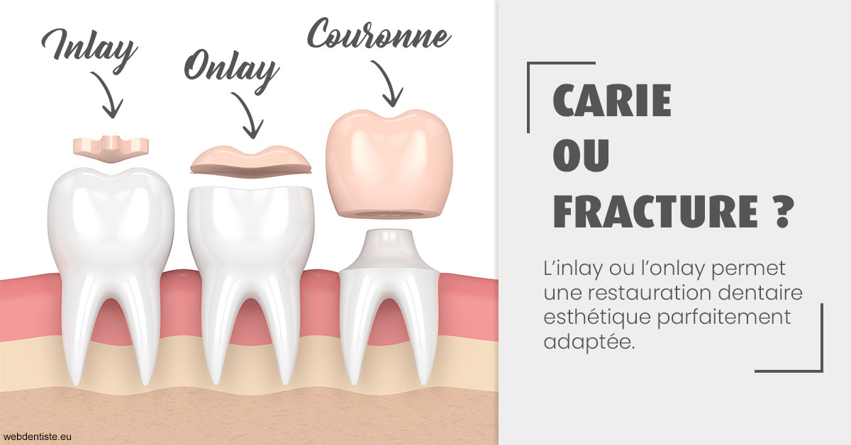 https://dr-juzan-cecile.chirurgiens-dentistes.fr/T2 2023 - Carie ou fracture 1
