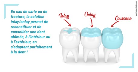 https://dr-juzan-cecile.chirurgiens-dentistes.fr/L'INLAY ou l'ONLAY