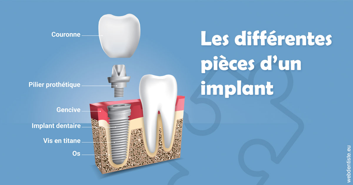 https://dr-juzan-cecile.chirurgiens-dentistes.fr/Les différentes pièces d’un implant 1