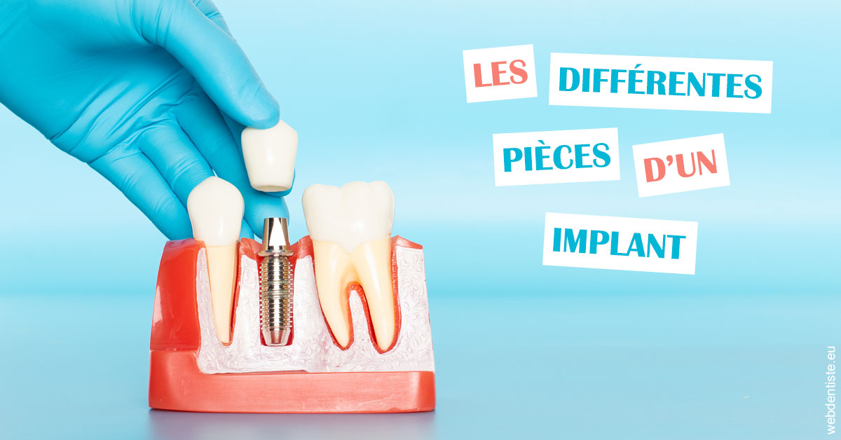 https://dr-juzan-cecile.chirurgiens-dentistes.fr/Les différentes pièces d’un implant 2